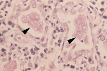 Pneumocystis carinii en el pulmon de un animal con PSCID.