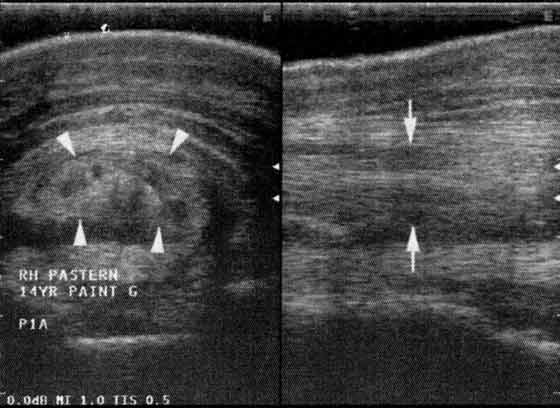 Diffuse tearing of the DDFT in Zone P1A in a 14-yr-old Paint ranch horse with acute onset lameness and digital sheath distention.
