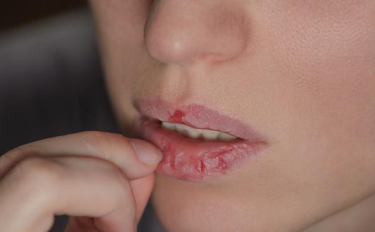 https://media.istockphoto.com/photos/dermatillomania-skin-picking-woman-has-bad-habit-to-pick-her-lips-picture-id900475670?b=1&k=6&m=900475670&s=170667a&w=0&h=8gI_MVO7tf70qFNnVuQTqViUfs224ofarhofobbd1kY=