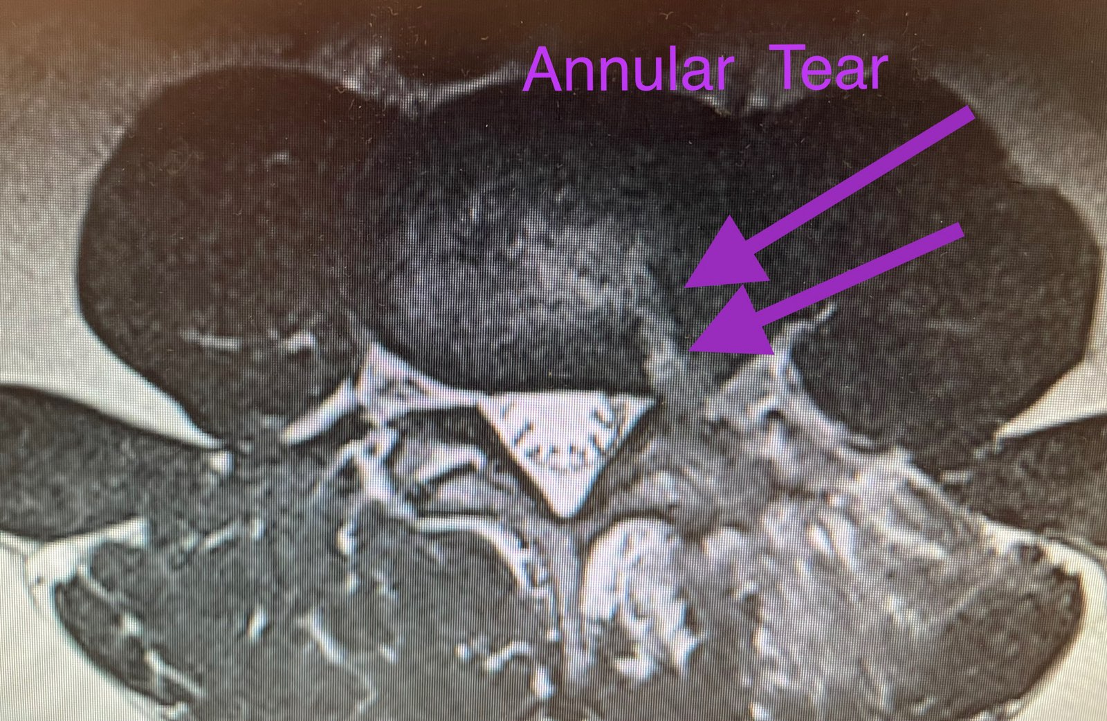 annular-tear-foraminal-stenosis