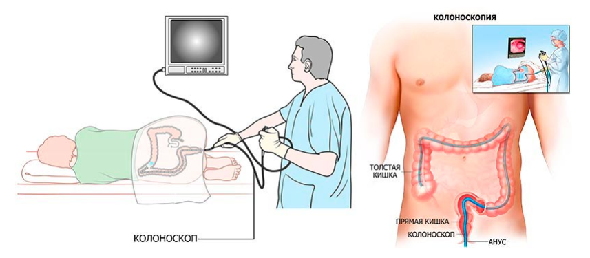 Процесс колоноскопии. Диагностика колоноскопия Толстого кишечника. Колоноскопия прямой и толстой кишки. Колоноскопия схема проведения. Эндоскопическое исследование толстой кишки колоноскопия.