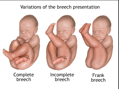 breech position in pregnancy