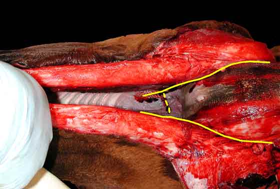 Lines of dissection of the lateral walls of the pharynx.