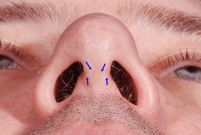 Nâng mũi bằng sụn tự thân bị co ngót khắc phục bằng cách nào?