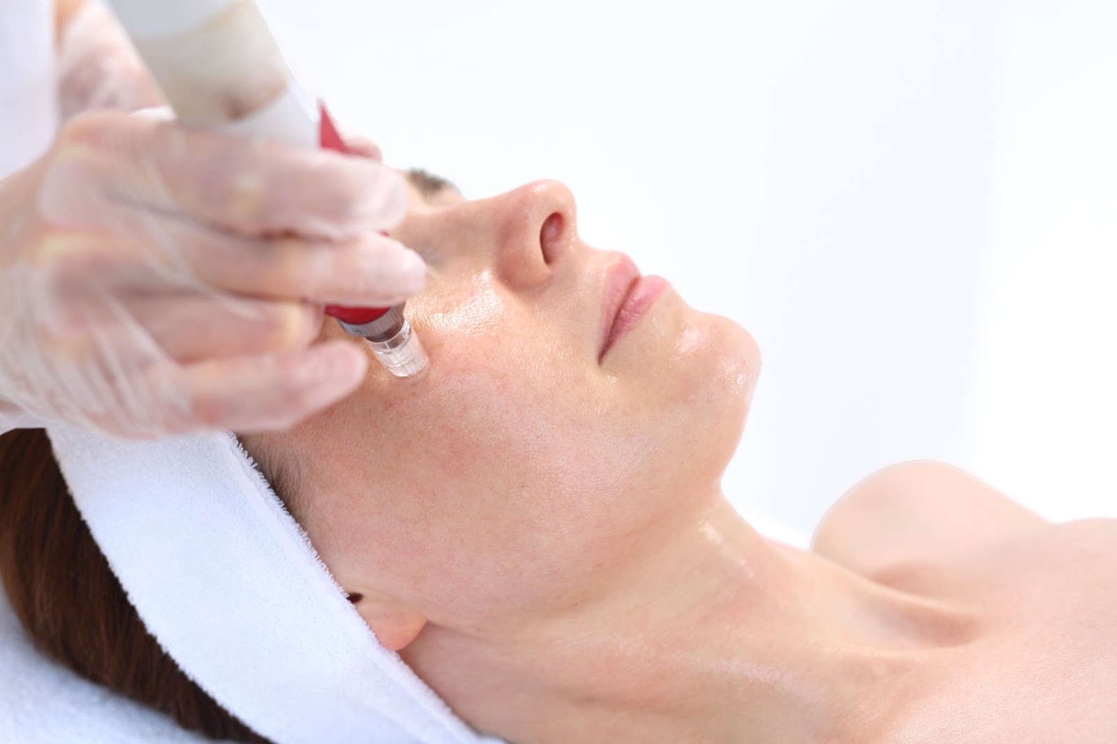 Common Questions About Microneedling