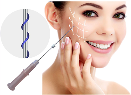 Căng chỉ collagen là phương pháp cấy các sợi chỉ siêu mãnh xuống da bằng các thiết bị chuyên dụng.